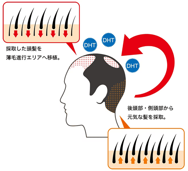 後頭部・側頭部から元気な毛を採取。最初した頭髪を薄毛進行エリアへ移植。